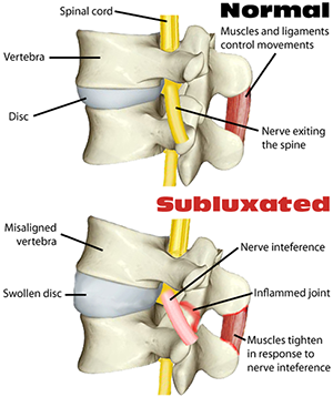 Chiropractic Care Subluxation Stages